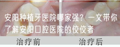 安阳种植牙医院哪家强？一文带你了解安阳口腔医院的佼佼者(图1)