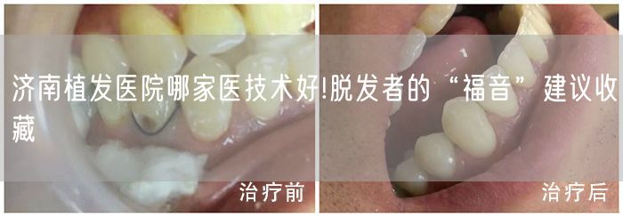 济南植发医院哪家医技术好!脱发者的“福音”建议收藏