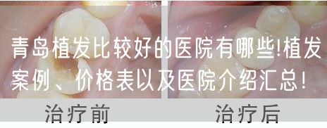 青岛植发比较好的医院有哪些!植发案例、价格表以及医院介绍汇总！