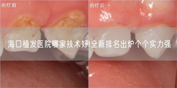 海口植发医院哪家技术好!全新排名出炉个个实力强