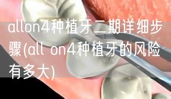 allon4种植牙二期详细步骤(all on4种植牙的风险有多大)