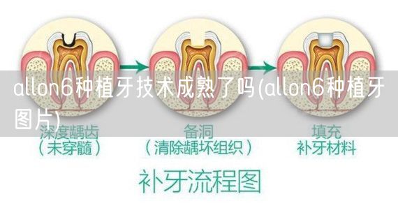 allon6种植牙技术成熟了吗(allon6种植牙图片)