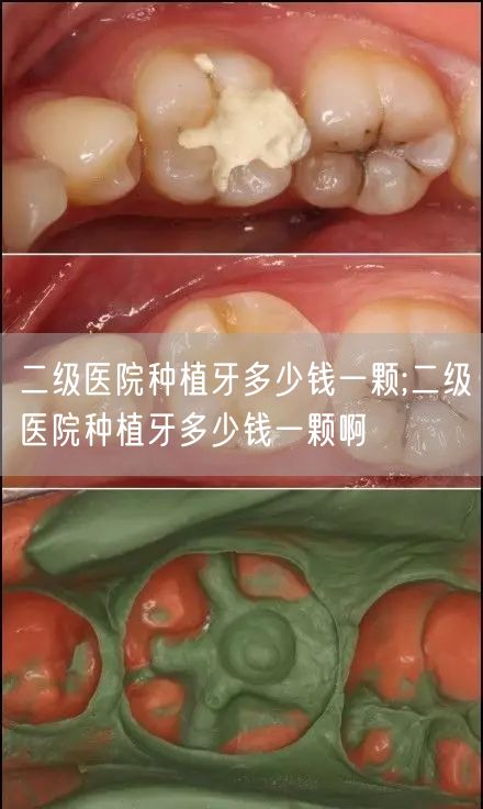 二级医院种植牙多少钱一颗;二级医院种植牙多少钱一颗