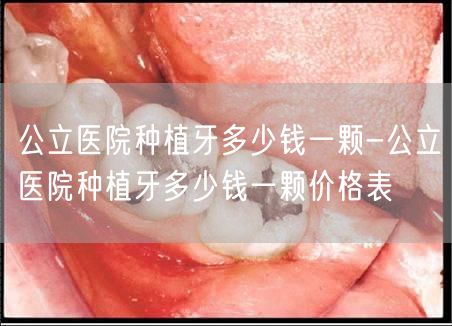 公立医院种植牙多少钱一颗-公立医院种植牙多少钱一颗