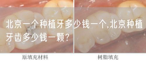 北京一个种植牙多少钱一个,北京种植牙齿多少钱一颗？