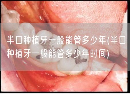 半口种植牙一般能管多少年(半口种植牙一般能管多少年时间)