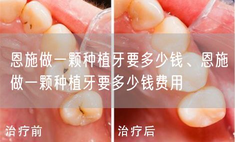 恩施做一颗种植牙要多少钱、恩施做一颗种植牙要多少钱费用