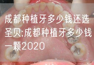 成都种植牙多少钱还选圣贝;成都种植牙多少钱一颗2020