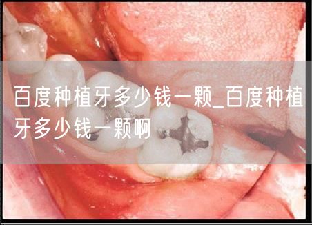 百度种植牙多少钱一颗_百度种植牙多少钱一颗啊