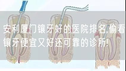 安利厦门镶牙好的医院排名,偷看镶牙便宜又好还可靠的诊所!