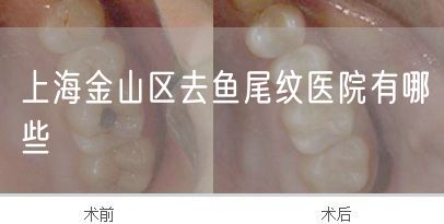 上海金山区去鱼尾纹医院有哪些