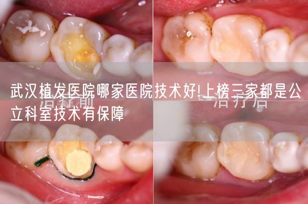 武汉植发医院哪家医院技术好!上榜三家都是公立科室技术有保障