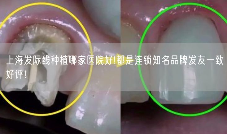 上海发际线种植哪家医院好!都是连锁知名品牌发友一致好评！