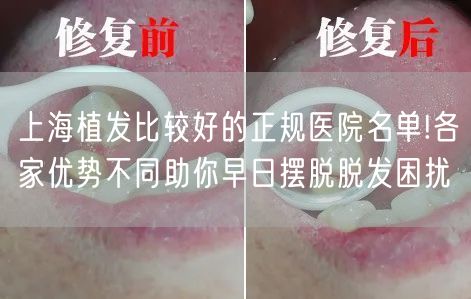 上海植发比较好的正规医院名单!各家优势不同助你早日摆脱脱发困扰