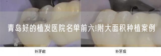 青岛好的植发医院名单前六!附大面积种植案例