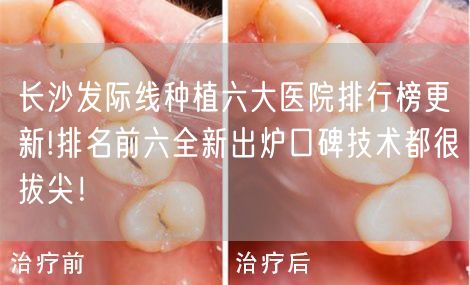长沙发际线种植六大医院排行榜更新!排名前六全新出炉口碑技术都很拔尖！