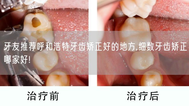 牙友推荐呼和浩特牙齿矫正好的地方,细数牙齿矫正哪家好!
