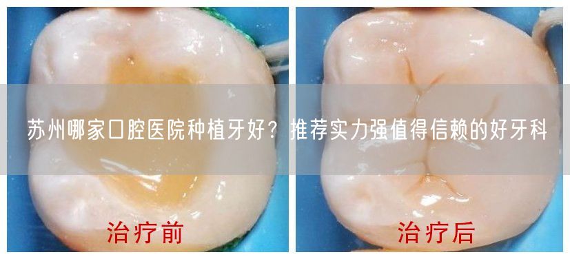苏州哪家口腔医院种植牙好？推荐实力强值得信赖的好牙科