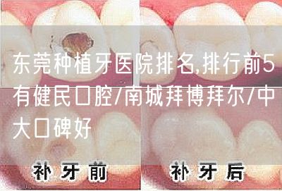 东莞种植牙医院排名,排行前5有健民口腔/南城拜博拜尔/中大口碑好