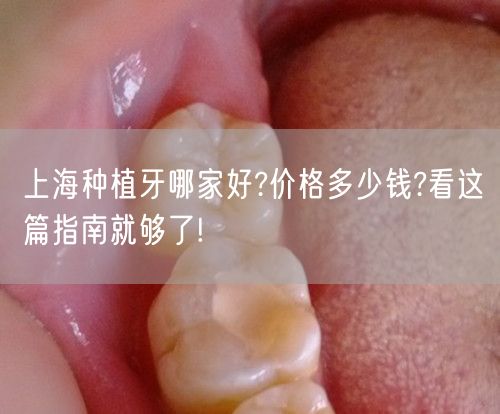 上海种植牙哪家好?价格多少钱?看这篇指南就够了!