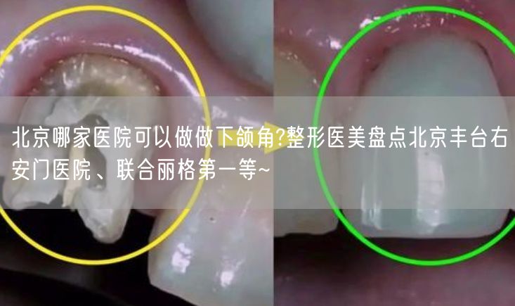 北京哪家医院可以做做下颌角?整形医美盘点北京丰台右安门医院、联合丽格第一等~