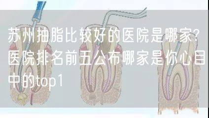 苏州抽脂比较好的医院是哪家?医院排名前五公布哪家是你心目中的top1