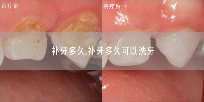 补牙多久,补牙多久可以洗牙