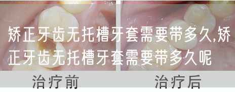矫正牙齿无托槽牙套需要带多久,矫正牙齿无托槽牙套需要带多久呢(图1)