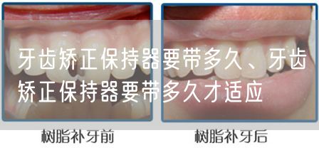 牙齿矫正保持器要带多久、牙齿矫正保持器要带多久才适应