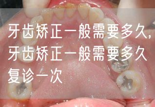 牙齿矫正一般需要多久,牙齿矫正一般需要多久复诊一次