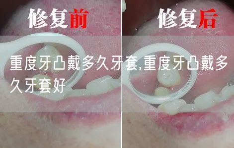 重度牙凸戴多久牙套,重度牙凸戴多久牙套好(图1)