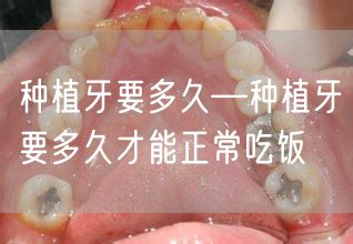 种植牙要多久—种植牙要多久才能正常吃饭