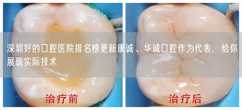 深圳好的口腔医院排名榜更新康诚、华诚口腔作为代表，给你展现实际技术