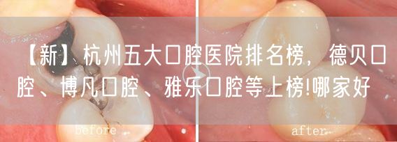 【新】杭州五大口腔医院排名榜，德贝口腔、博凡口腔、雅乐口腔等上榜!哪家好