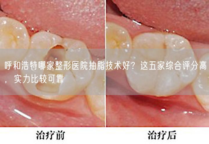 呼和浩特哪家整形医院抽脂技术好？这五家综合评分高，实力比较可靠