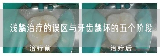浅龋治疗的误区与牙齿龋坏的五个阶段(图1)