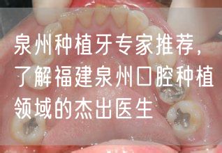 泉州种植牙专家推荐，了解福建泉州口腔种植领域的杰出医生(图1)