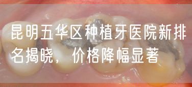 昆明五华区种植牙医院新排名揭晓，价格降幅显著