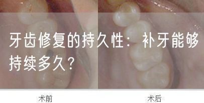 牙齿修复的持久性：补牙能够持续多久？