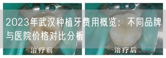 2023年武汉种植牙费用概览：不同品牌与医院价格对比分析