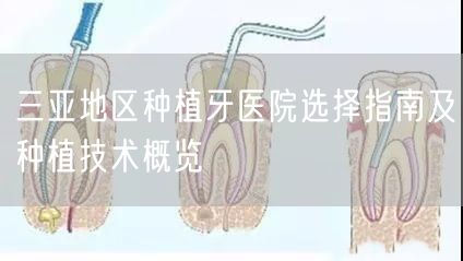 三亚地区种植牙医院选择指南及种植技术概览