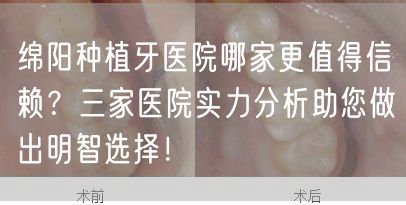 绵阳种植牙医院哪家更值得信赖？三家医院实力分析助您做出明智选择！(图1)