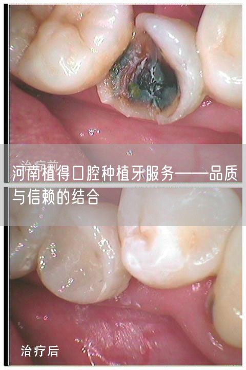 河南植得口腔种植牙服务——品质与信赖的结合(图1)