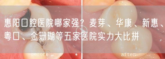 惠阳口腔医院哪家强？麦芽、华康、新惠、粤口、金珊瑚等五家医院实力大比拼