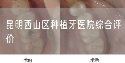 昆明西山区种植牙医院综合评价(图1)