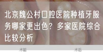 北京魏公村口腔医院种植牙服务哪家更出色？多家医院综合比较分析