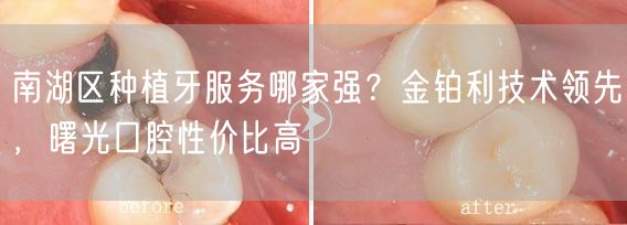 南湖区种植牙服务哪家强？金铂利技术领先，曙光口腔性价比高(图1)
