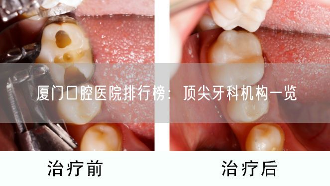 厦门口腔医院排行榜：顶尖牙科机构一览(图1)