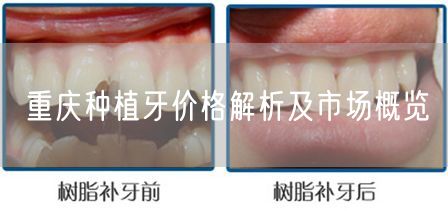 重庆种植牙价格解析及市场概览(图1)
