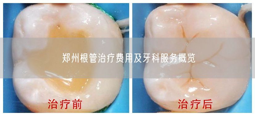 郑州根管治疗费用及牙科服务概览(图1)
